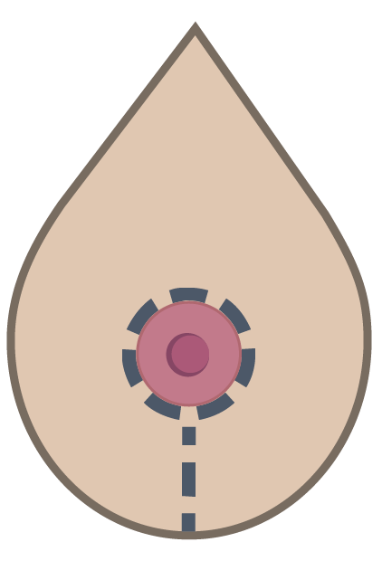Illustration af Brystløft lollipop teknik hos Klinik Kongeporten