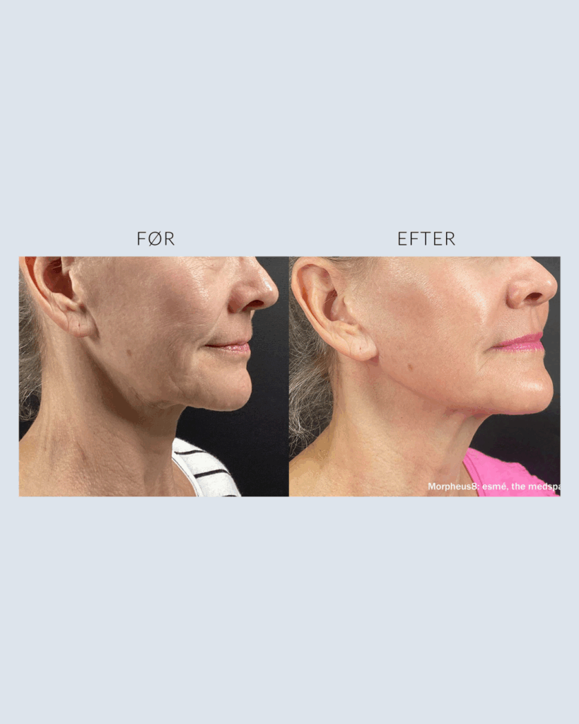 før.efter morpheus8 (2)