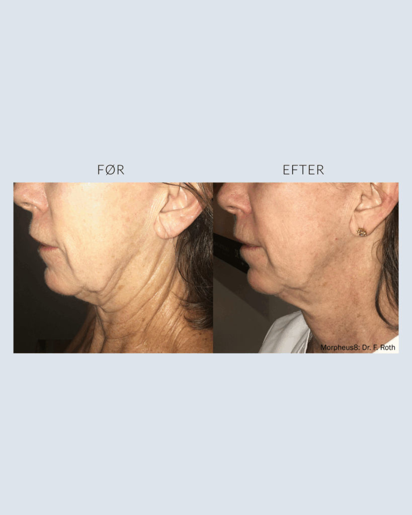 før.efter morpheus8 (2)