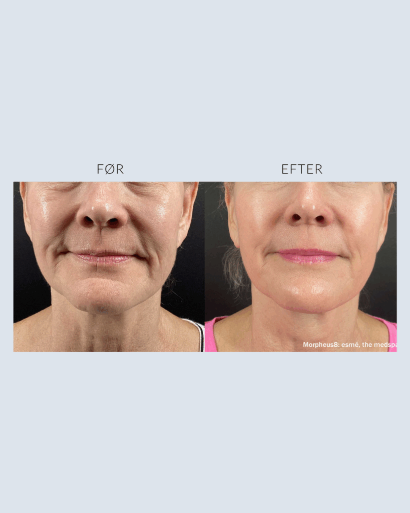 før.efter morpheus8 (3)