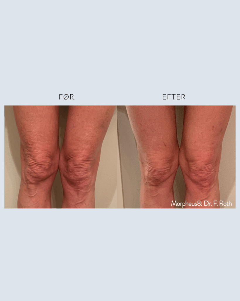 før.efter morpheus8 (3)