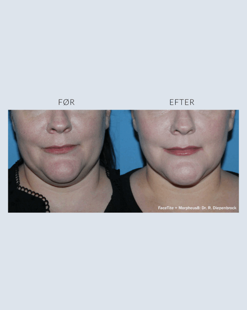 før.efter morpheus8 (4)