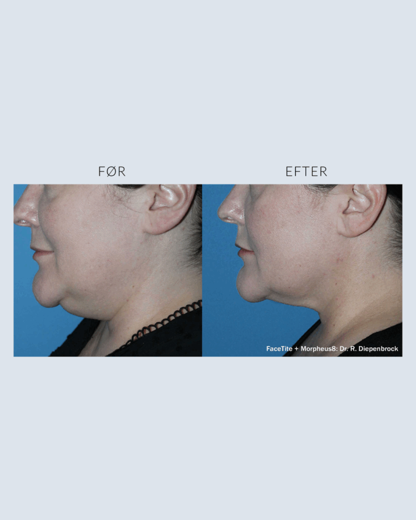 før.efter morpheus8 (5)