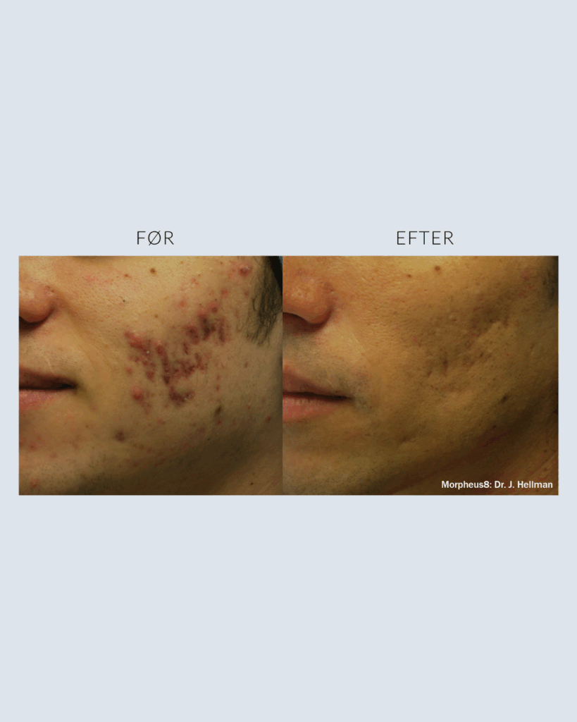 før.efter morpheus8 (6)