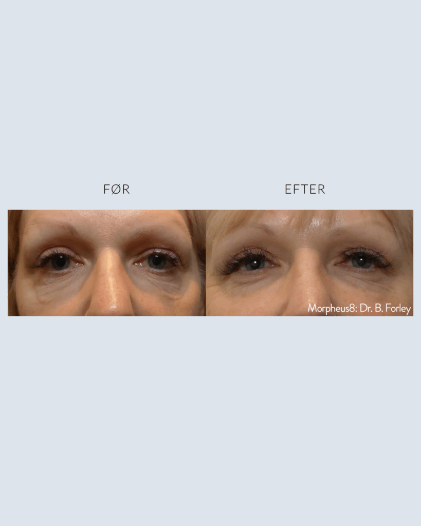 før.efter morpheus8 (7)