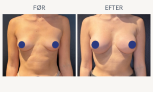Naturligt resultat efter brystoperation med implantat hos Klinik Kongeporten – se dine muligheder for brystkirurgi i trygge rammer.