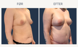 Før og efter Mommy Makeover med maveplastik, fedtsugning og brystoperation med implantater og eget fedt.